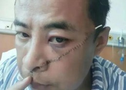 脸上留疤图片,见证岁月的痕迹